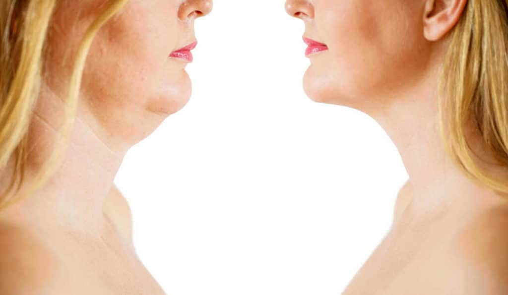 Double Chin treatment Waterlooville before and after results