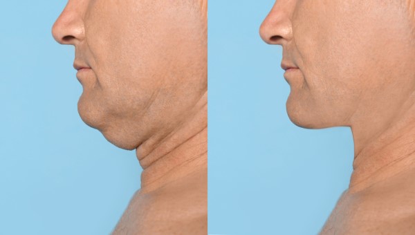 Which Non-Surgical Treatments Work Best for Jowls and Loose Skin Waterlooville?
