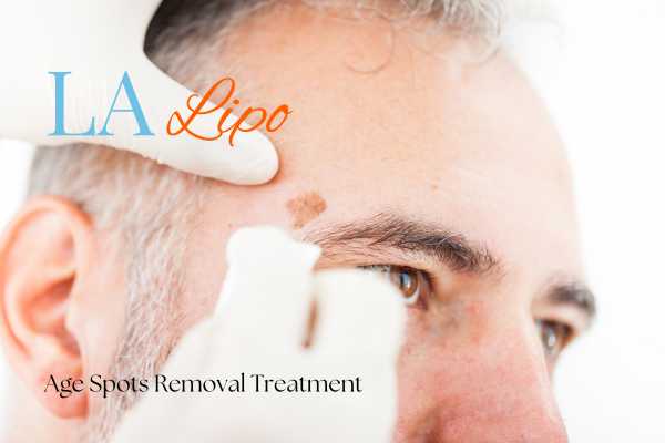 What Are the Most Effective Treatments for Age Spots Waterlooville?