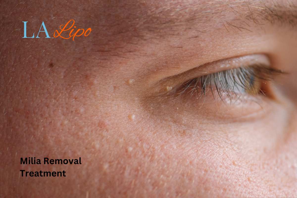 Cryopen Milia Removal: Is It the Easiest and Safest Option Waterlooville?