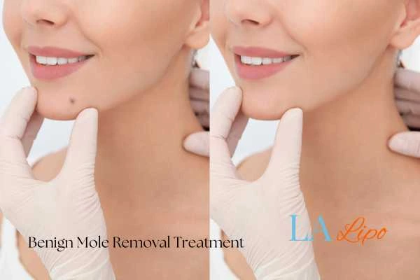 woman's before and after mole removal Waterlooville results