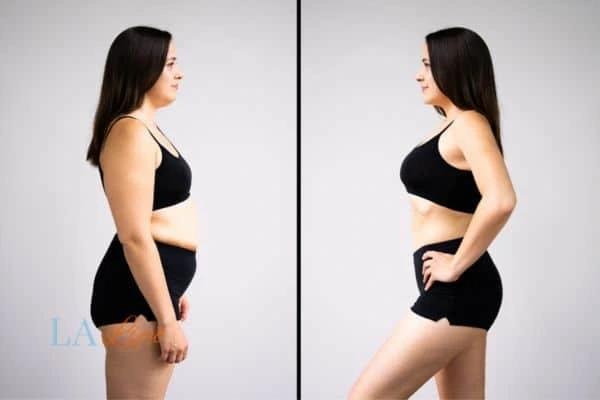 image of woman before and after results of LA-EMS Body Sculpting Waterlooville to help treat Diastasis recti