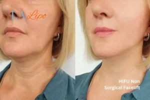 hi-fu for wrinkles Waterlooville before and after results