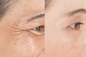 Before and after results of woman - HI-fu wrinkles reduction treatment Waterlooville