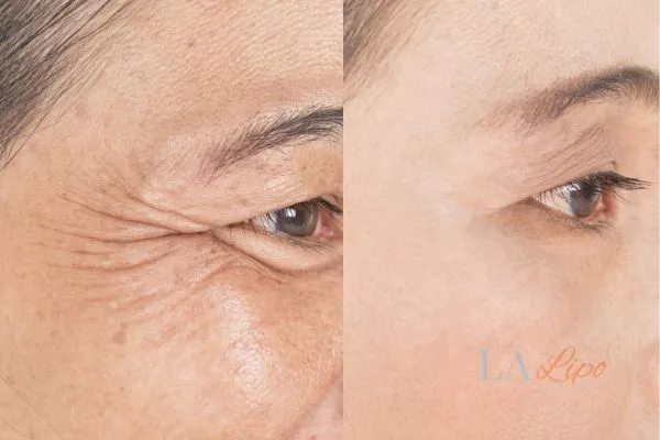 Before and after results of woman - HI-fu wrinkles reduction treatment Waterlooville
