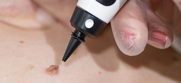 skin tag removal using cryopen Waterlooville