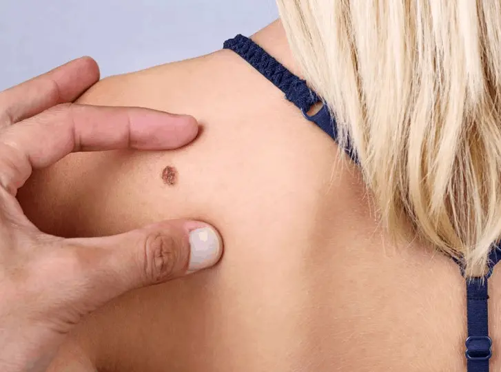 woman having mole removal Waterlooville consultation before treatment.