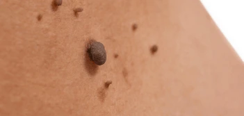 image of a skin tag Waterlooville
