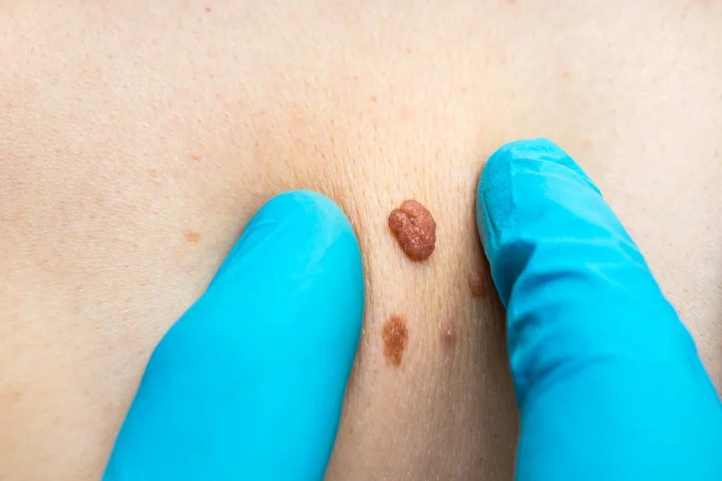 Consultant examining a skin tag Waterlooville