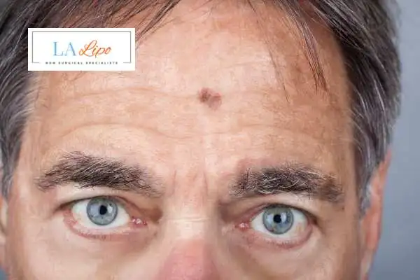 Solar Lentigo Removal Waterlooville image of man with mark on his forehead