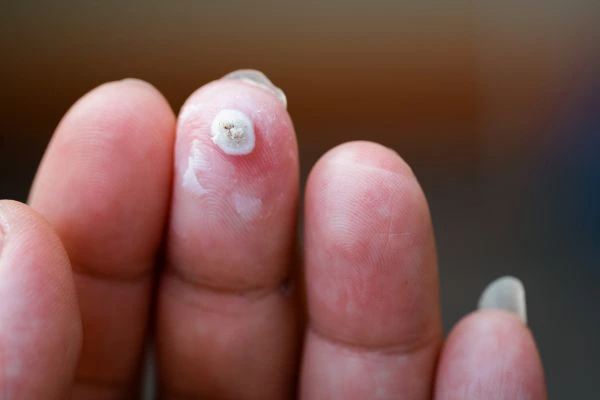 wart on person finger - cryotherapy to treat from LA LIPO Waterlooville