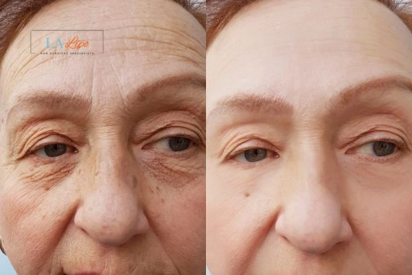 The powerful benefits of Morpheus8 Treatment Waterlooville - Call Our team today!