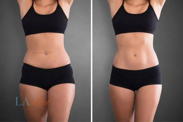 before and after results of non-surgical treatment to help a woman's body image and mental health Waterlooville