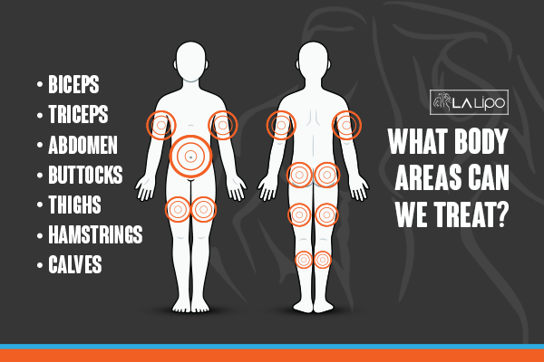 Diagram to show areas you can have LA-EMS Body Sculpting Treatment Waterlooville