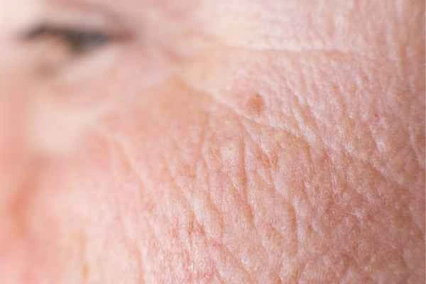 close up picture of a woman's face showing an age spot Waterlooville