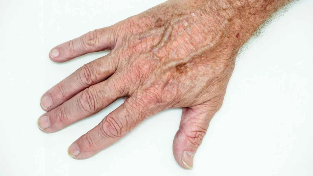 Male hand showing age spot Waterlooville