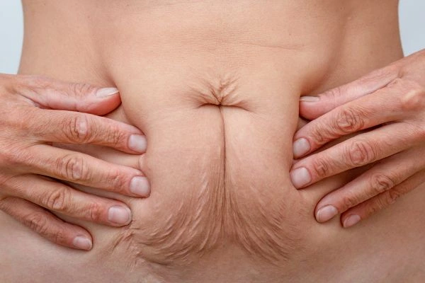 Should I Combine Diastasis Recti Treatment with Body Contouring for Better Results Waterlooville?