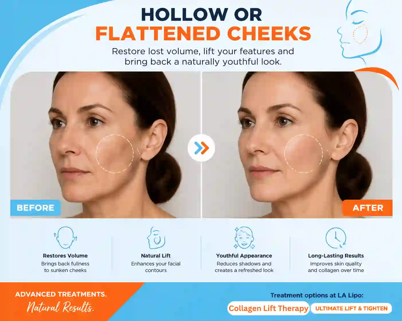 Sign #4: Hollow or Flattened Cheeks Waterlooville