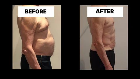 What Symptoms Can Diastasis Recti Cause in Men? Weak Core, Back Pain and Poor Posture Waterlooville